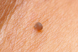 Как определить наличие вируса папилломы